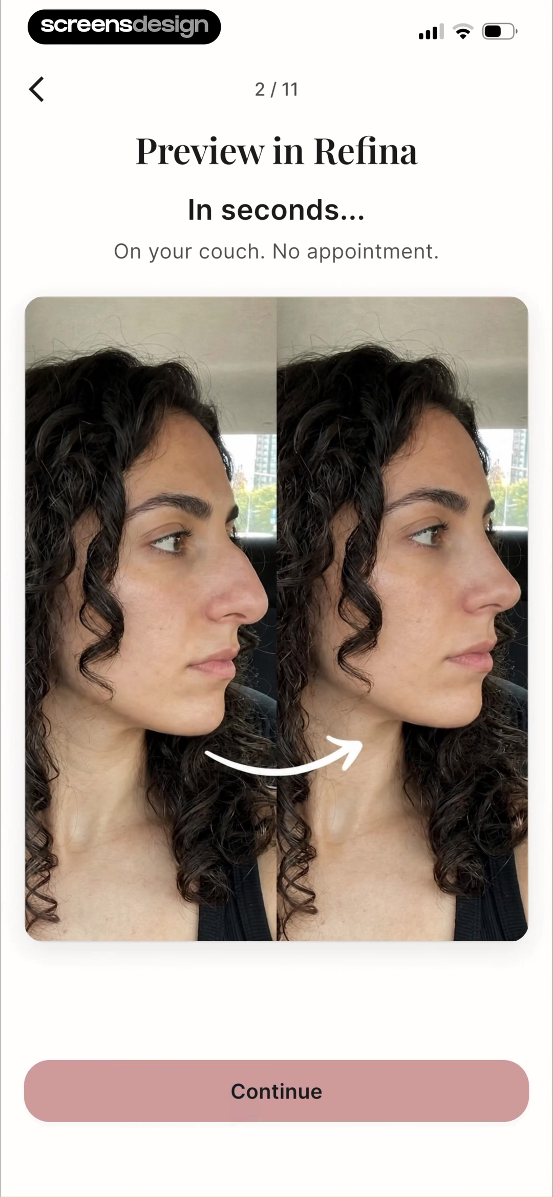 Refina onboarding screen with a facial before and after preview