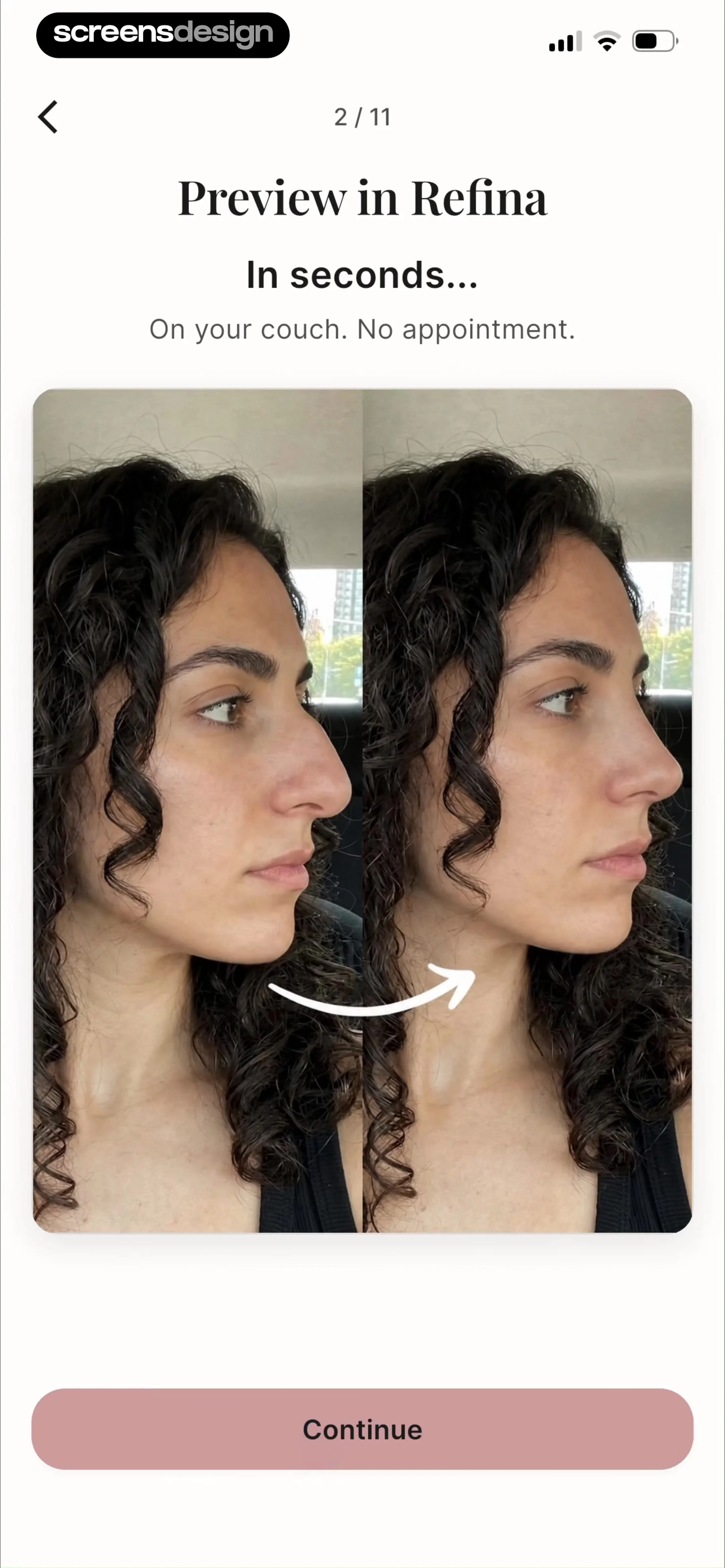 Refina: AI Plastic Surgery screen 4